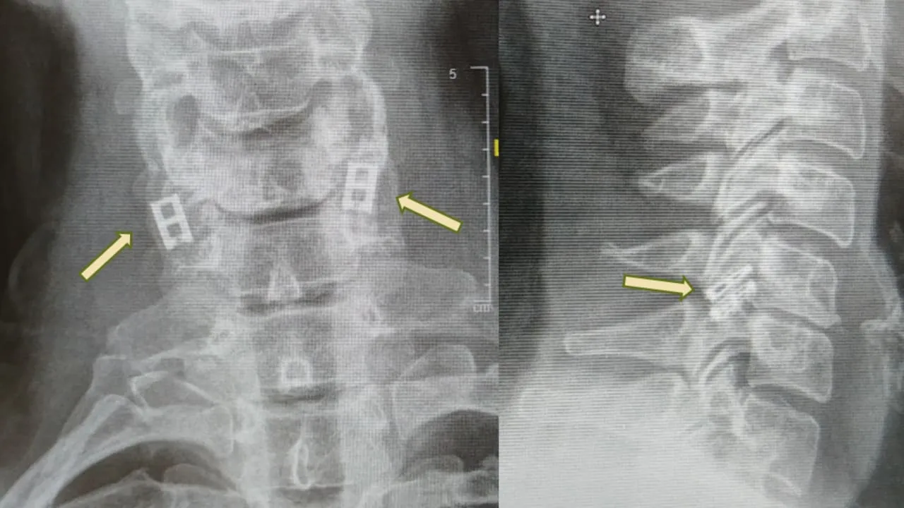 spinal cord transplant